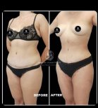 Fotos vor und nach Fettabsaugung am Bauch durch Dr. Cemal Firat