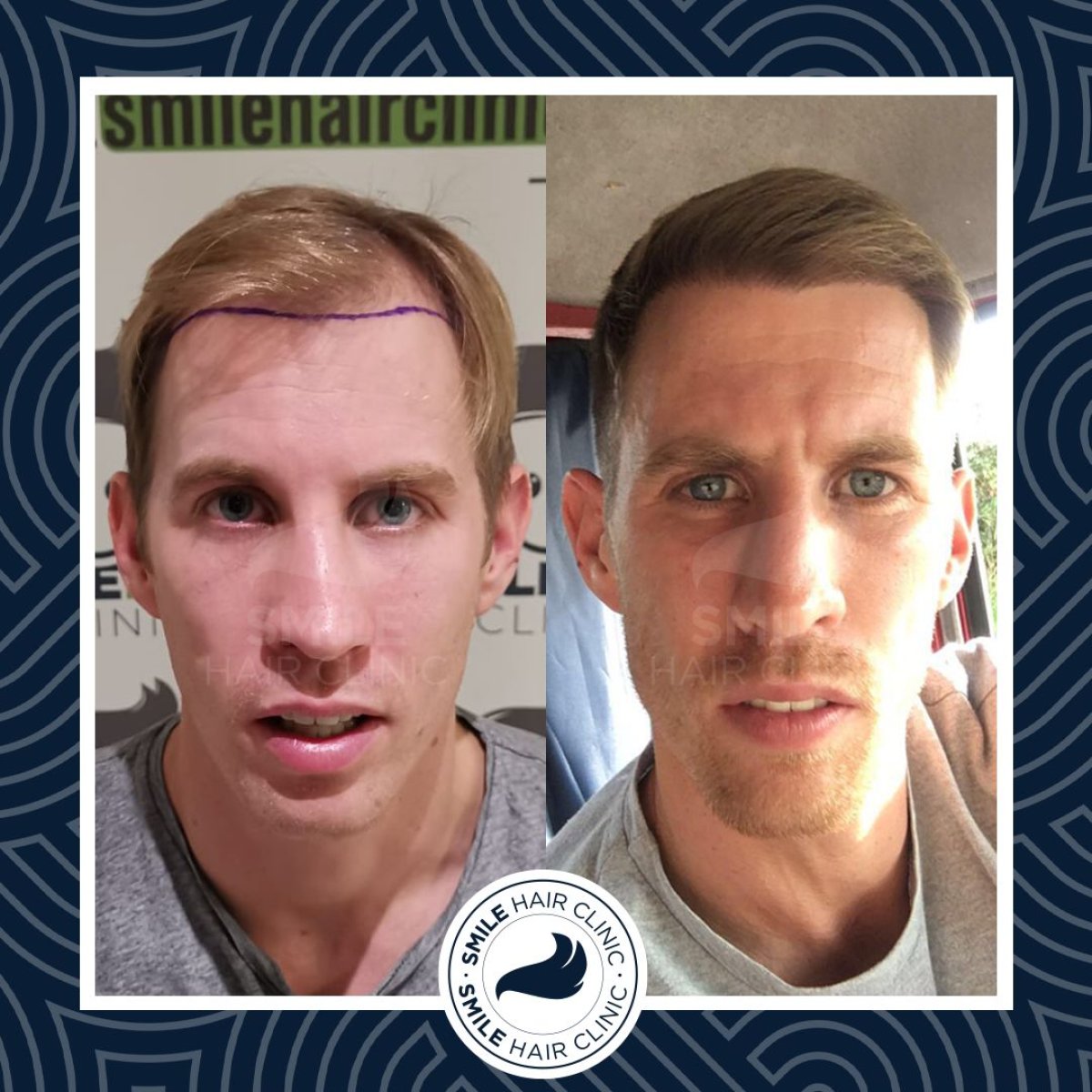 Before and after DHI hair transplant results at Smile Hair Clinic showing fuller hairline