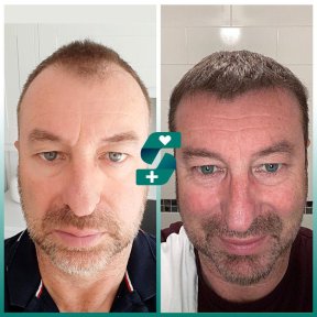 FUE & DHI Hair Transplant — 5,000 Grafts with Lifetime Warranty