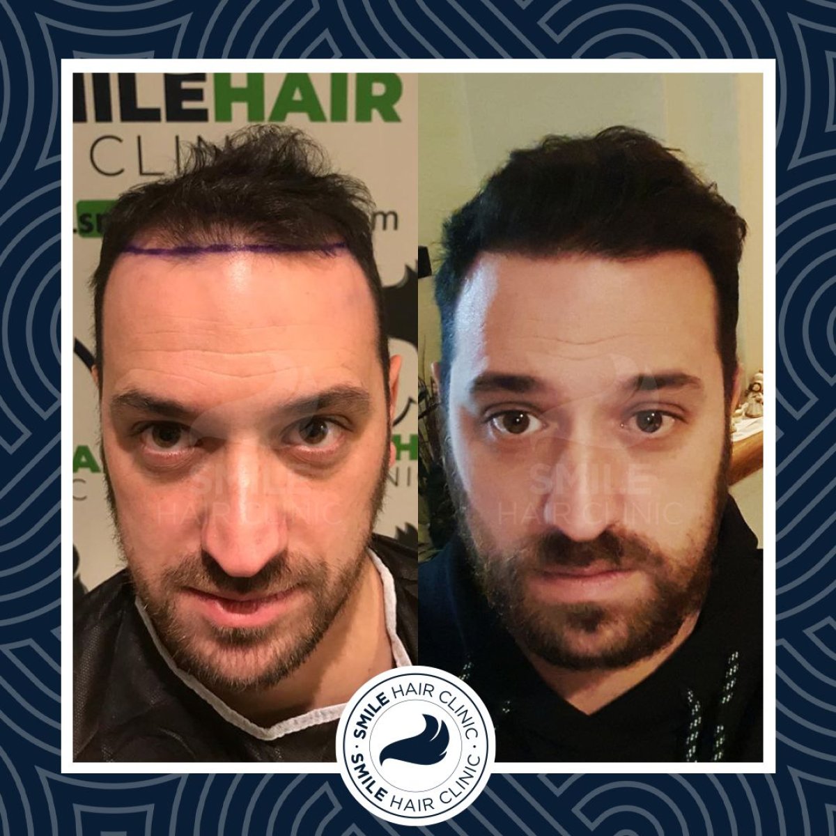 Before and after PRP hair loss treatment results at Smile Hair Clinic, improved hair density