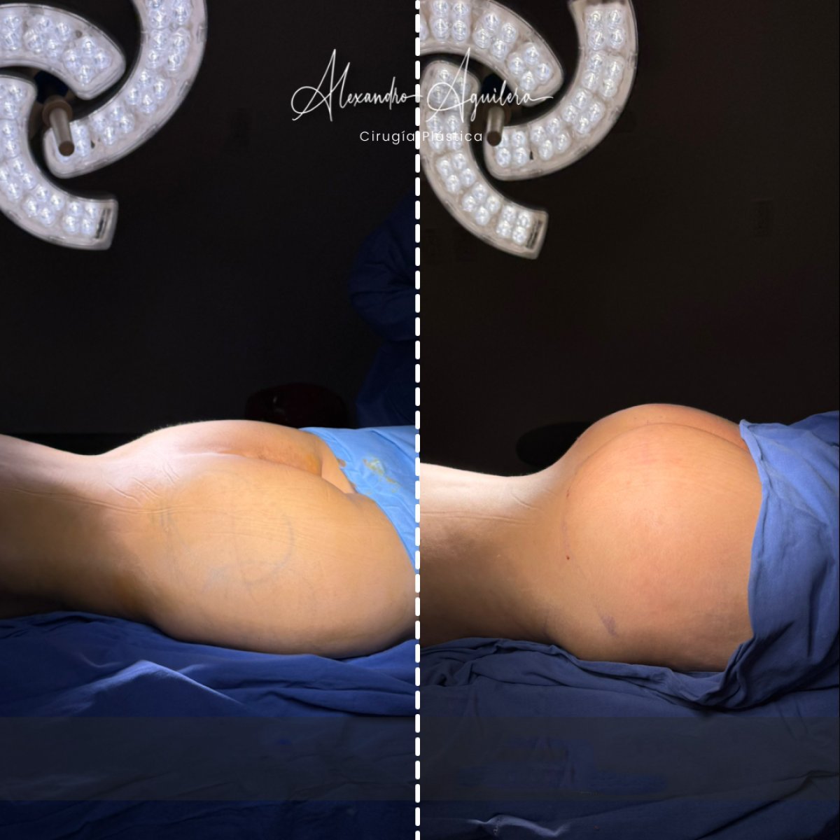 Resultado antes y después de implantes de glúteos en clínica Alexandre Aguilera – contorno mejorado