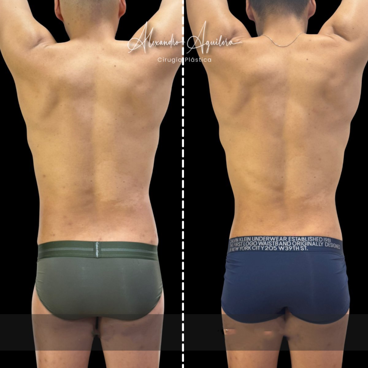 Résultats avant-après liposuccion homme, contour du dos amélioré chez Alexandre Aguilera