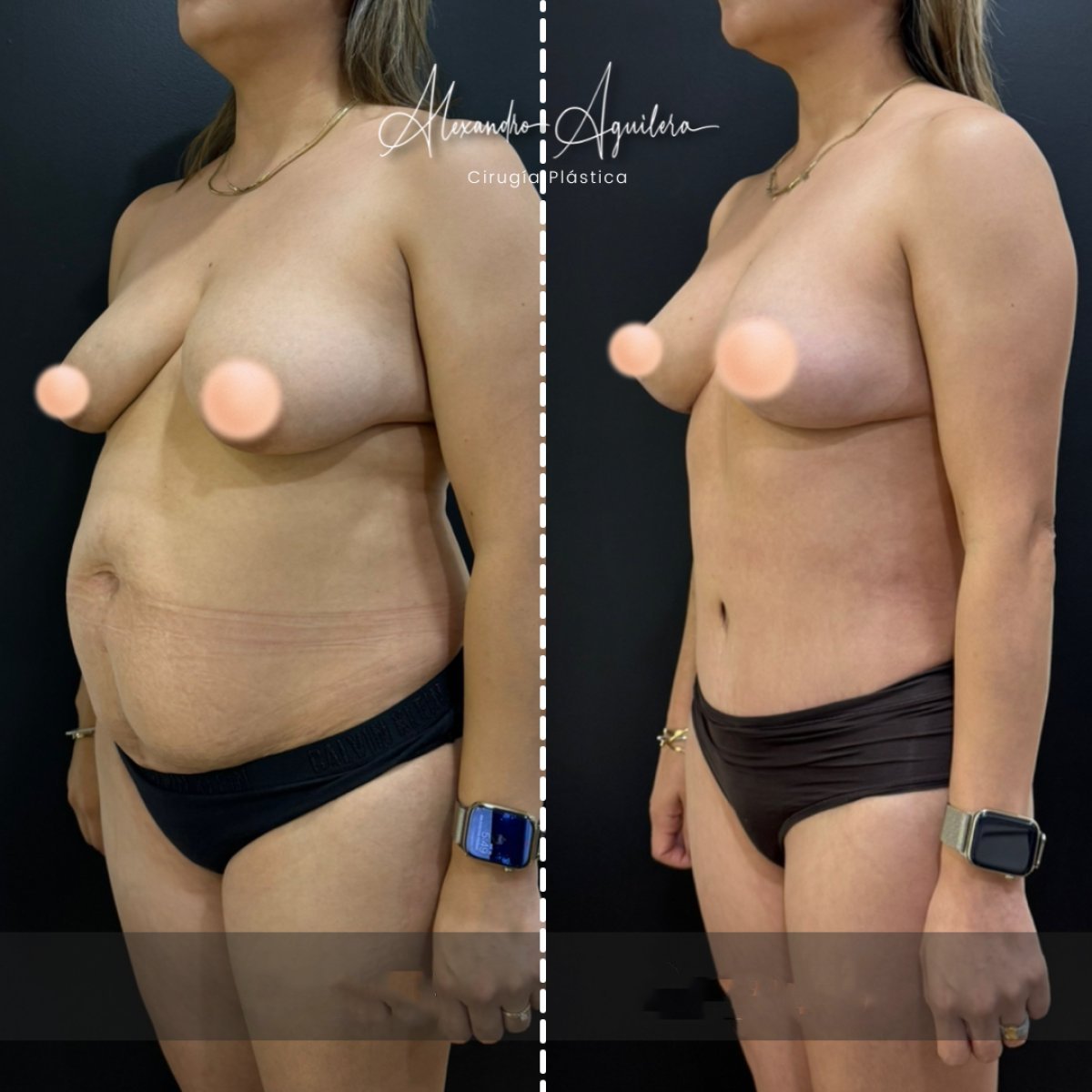 Résultats avant/après mommy makeover à la clinique Alexandre Aguilera – silhouette améliorée