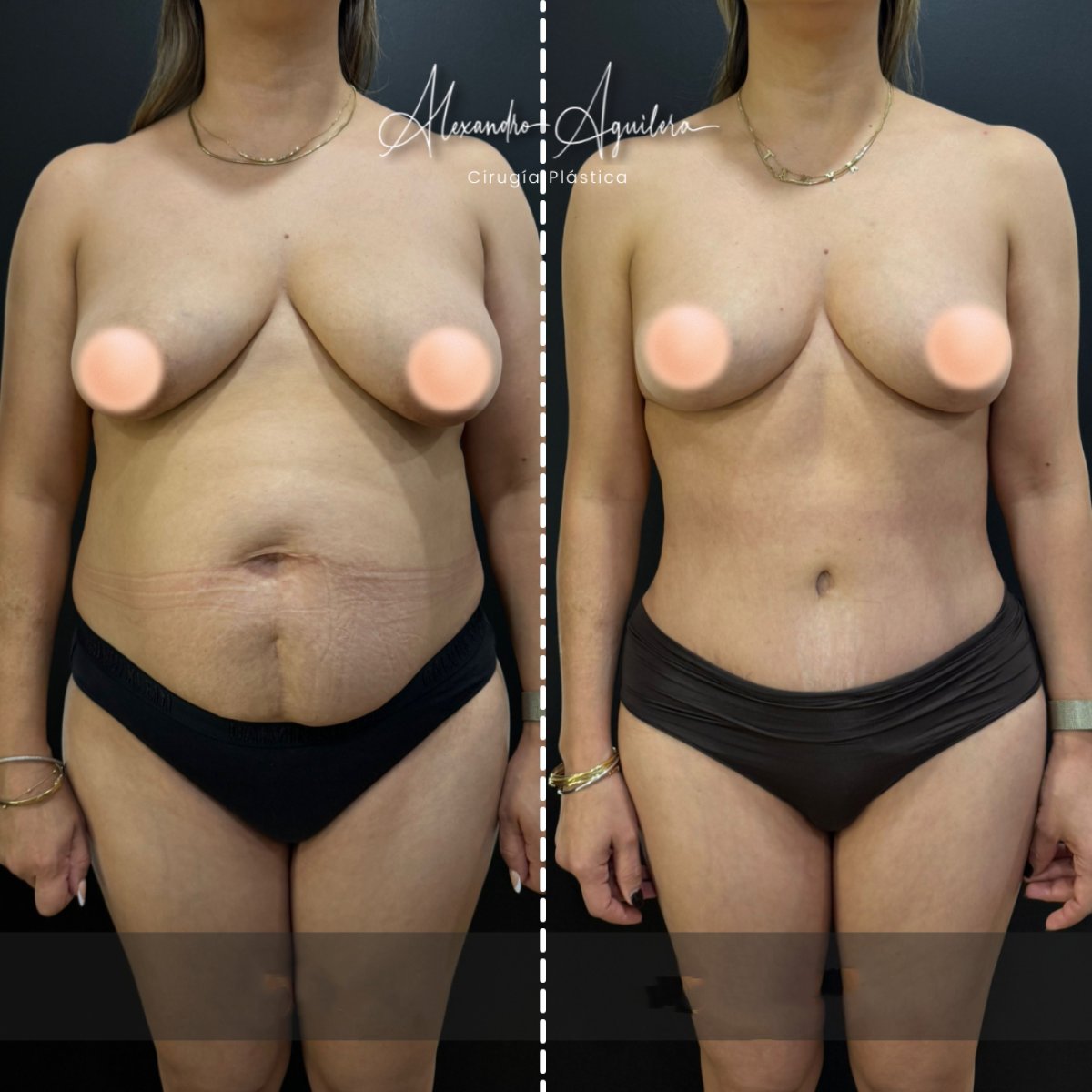 Resultados antes y después de mommy makeover en clínica Alexandre Aguilera – mejora corporal