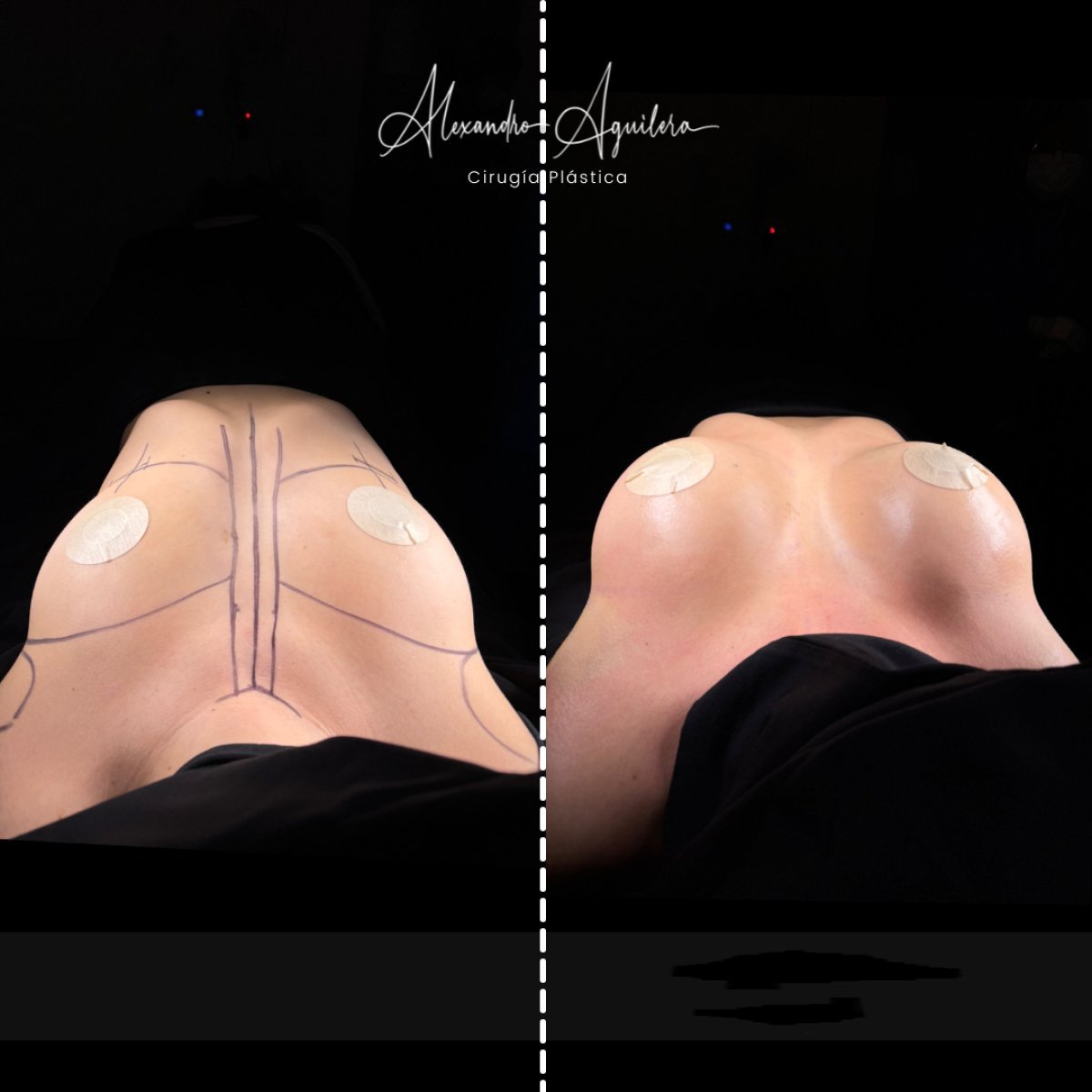 نتائج تكبير الثدي قبل وبعد في عيادة Alexandre Aguilera Cirugía Plástica