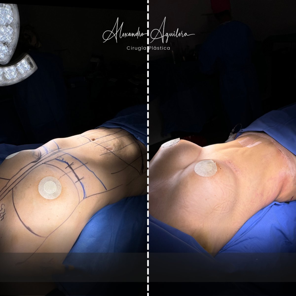 نتائج قبل وبعد عملية تجميل الأم في عيادة Alexandre Aguilera – تحسين واضح لتناسق الجسم