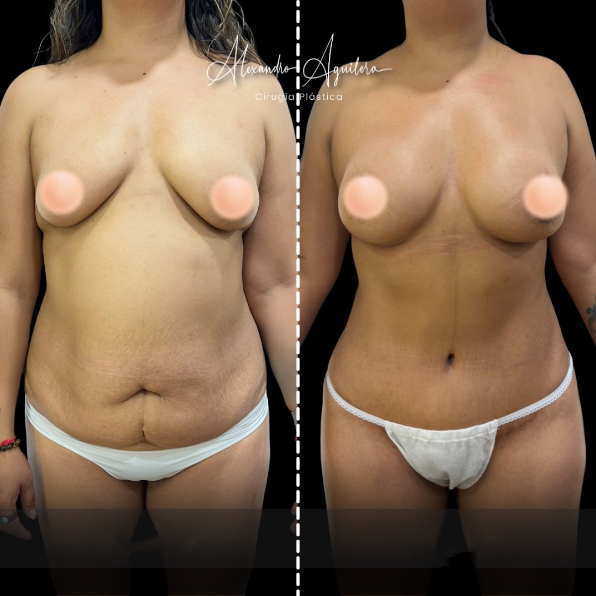 Résultats avant/après mommy makeover à la clinique Alexandre Aguilera, silhouette améliorée