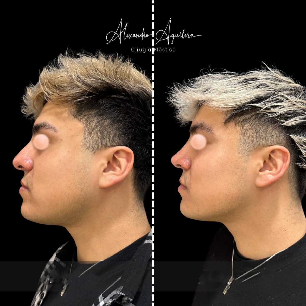 Male rhinoplasty before and after result at Alexandre Aguilera, improved nose profile