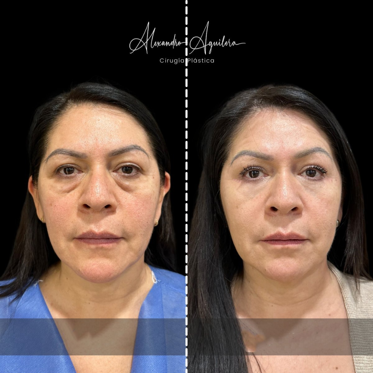 Résultats avant/après blépharoplastie supérieure et inférieure à la clinique Alexandre Aguilera