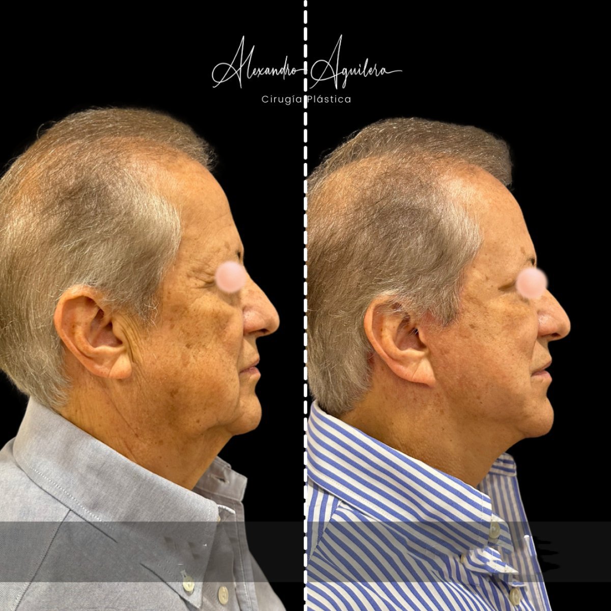 Résultats lifting visage avant/après à la clinique Alexandre Aguilera – cou et mâchoire liftés