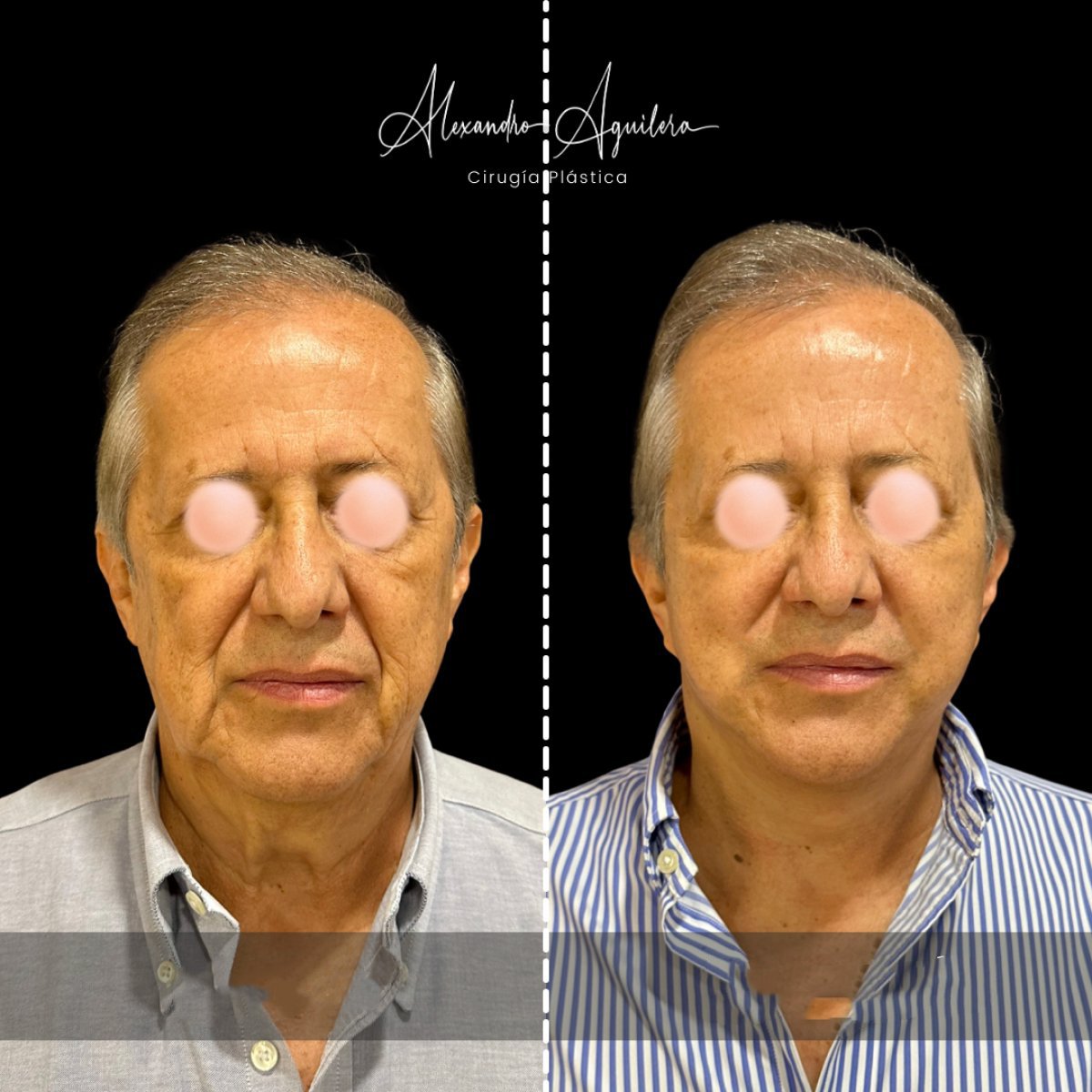 نتائج شد الوجه قبل وبعد في عيادة Alexandre Aguilera، تجديد شباب الوجه