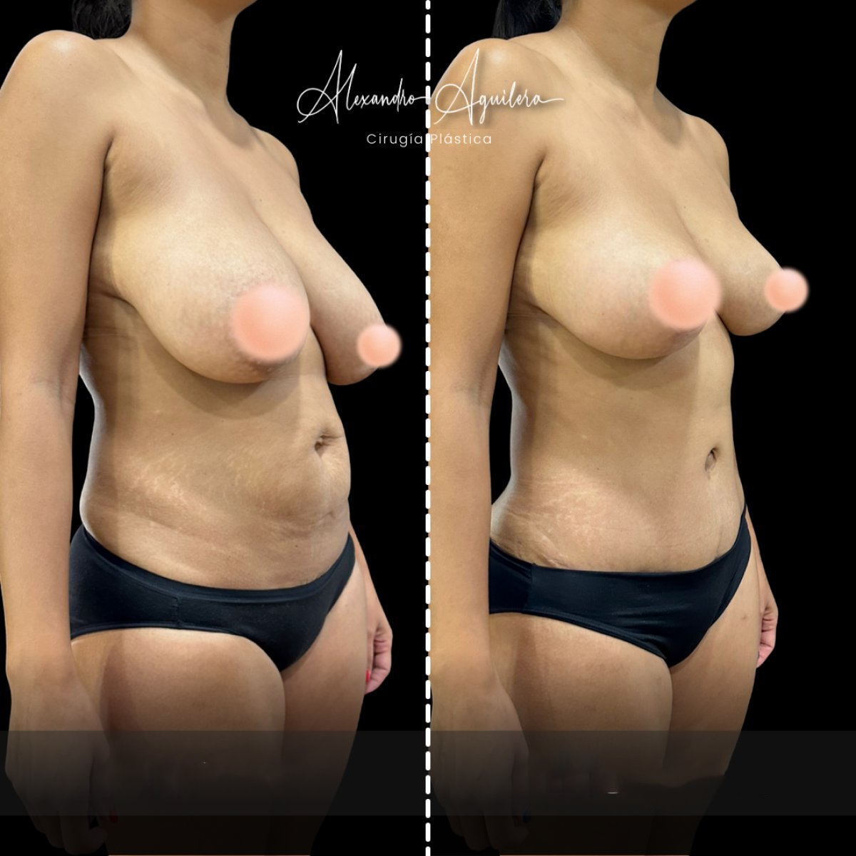 Mommy makeover before and after results at Alexandre Aguilera – body and breast contouring