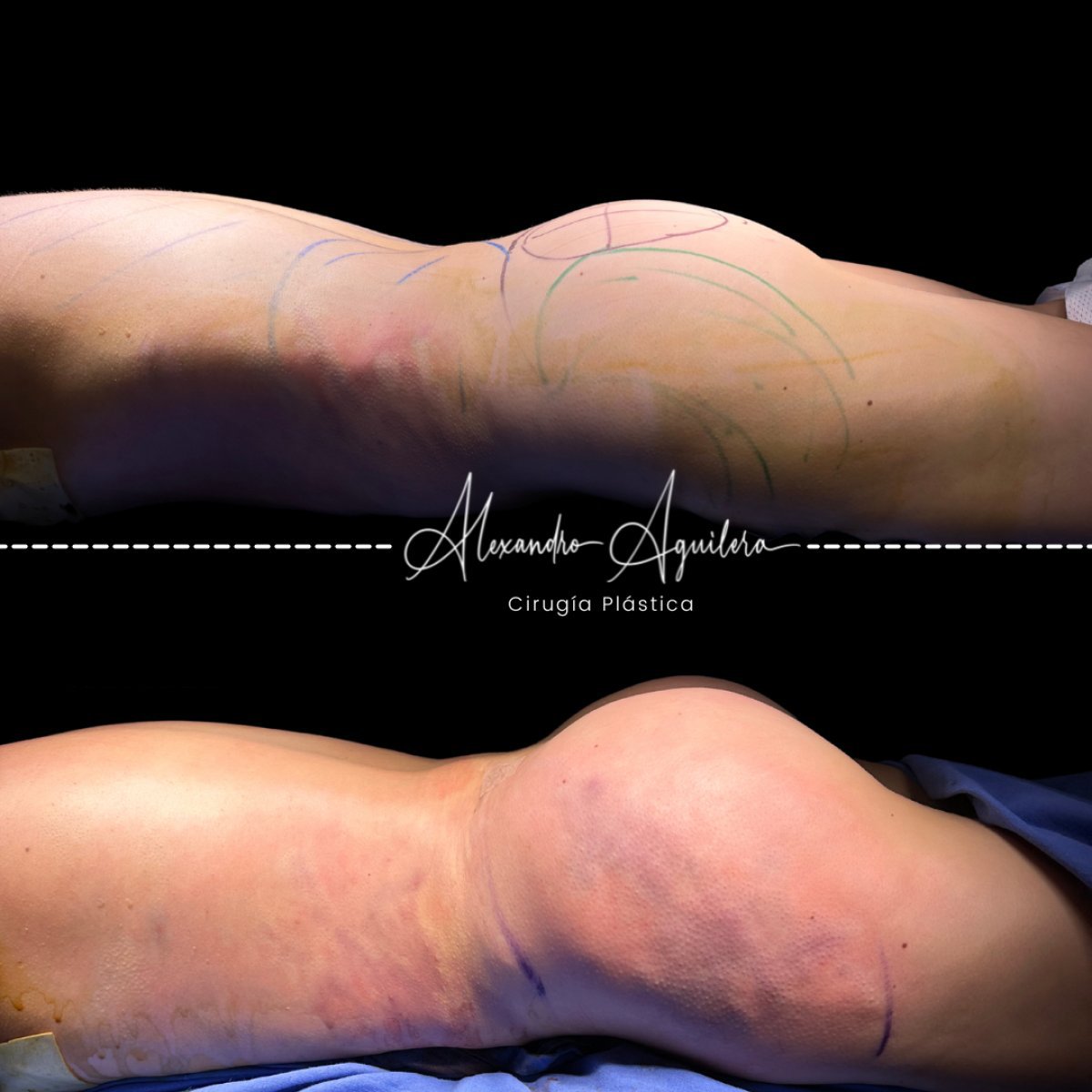 Resultados antes y después de Brazilian Butt Lift en clínica Alexandre Aguilera, curvas mejoradas
