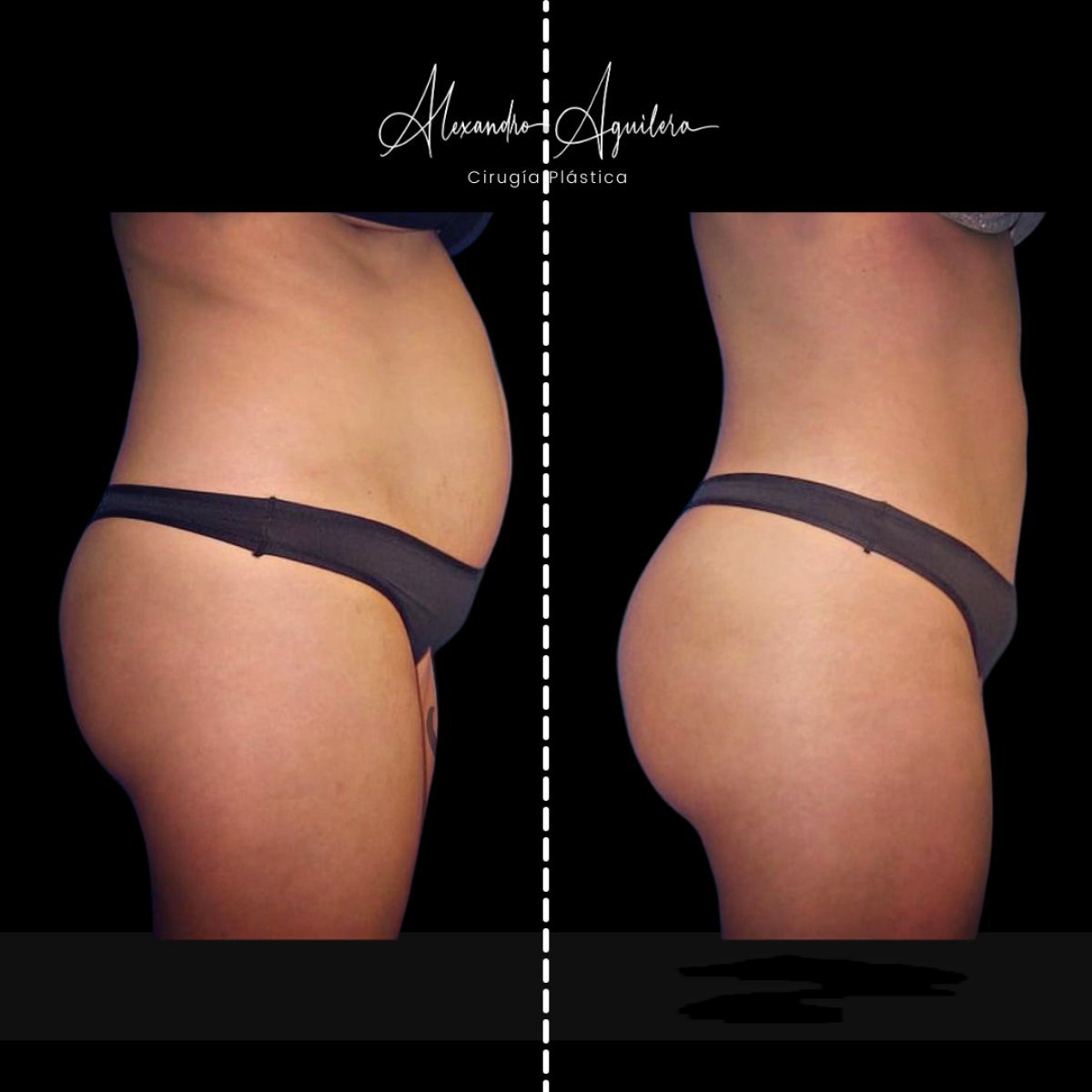 Résultats avant-après lipofilling chez Alexandre Aguilera, amélioration du contour corporel