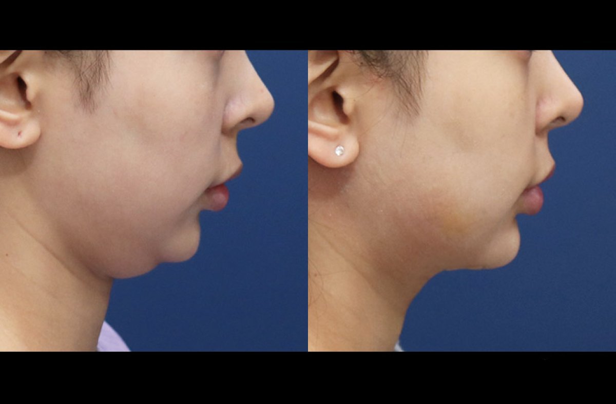 Résultats lifting du cou avant/après chez HERSHE Plastic Surgery Korea, contour amélioré