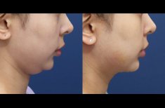 Fotos vor und nach Fettabsaugung durch Dr. 