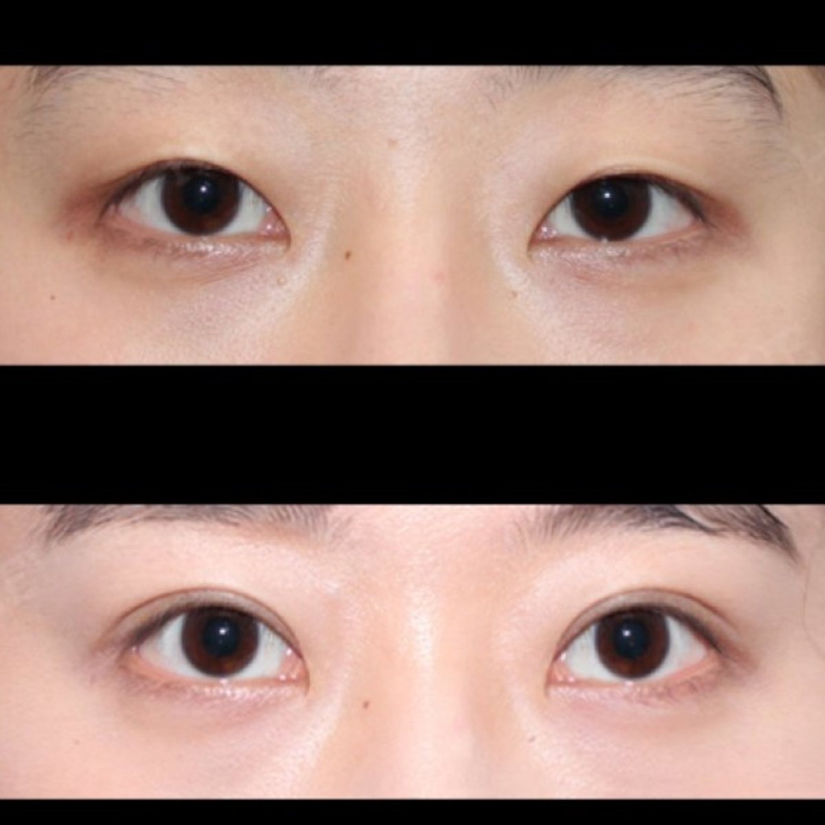 Resultados de blefaroplastia antes y después en HERSHE Plastic Surgery Korea, corrección de párpados