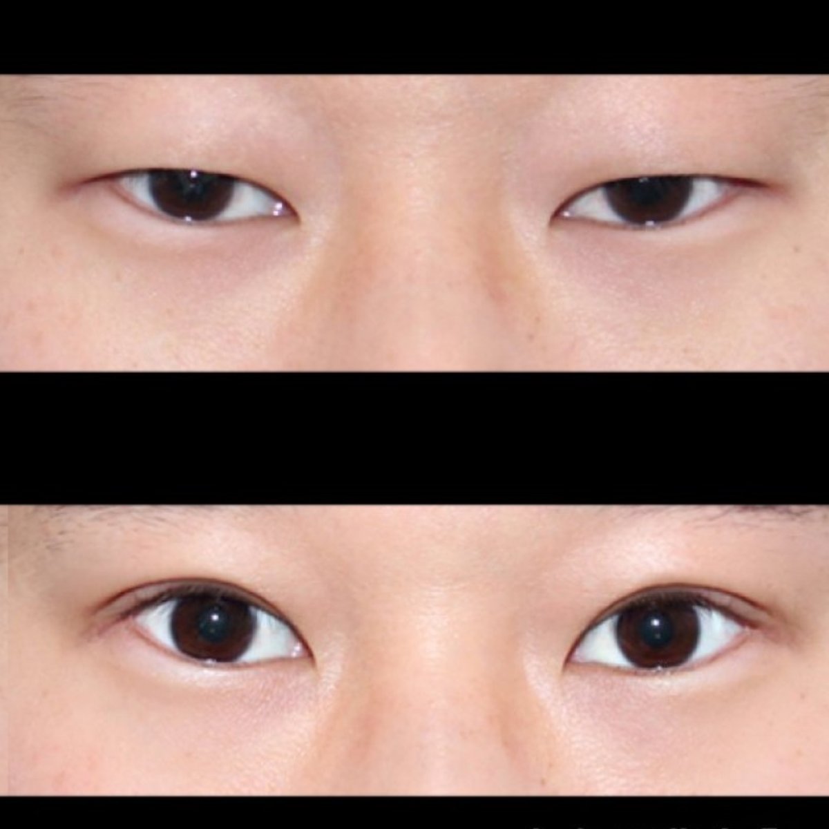 Résultats avant/après blépharoplastie chez HERSHE Plastic Surgery Korea, correction des paupières