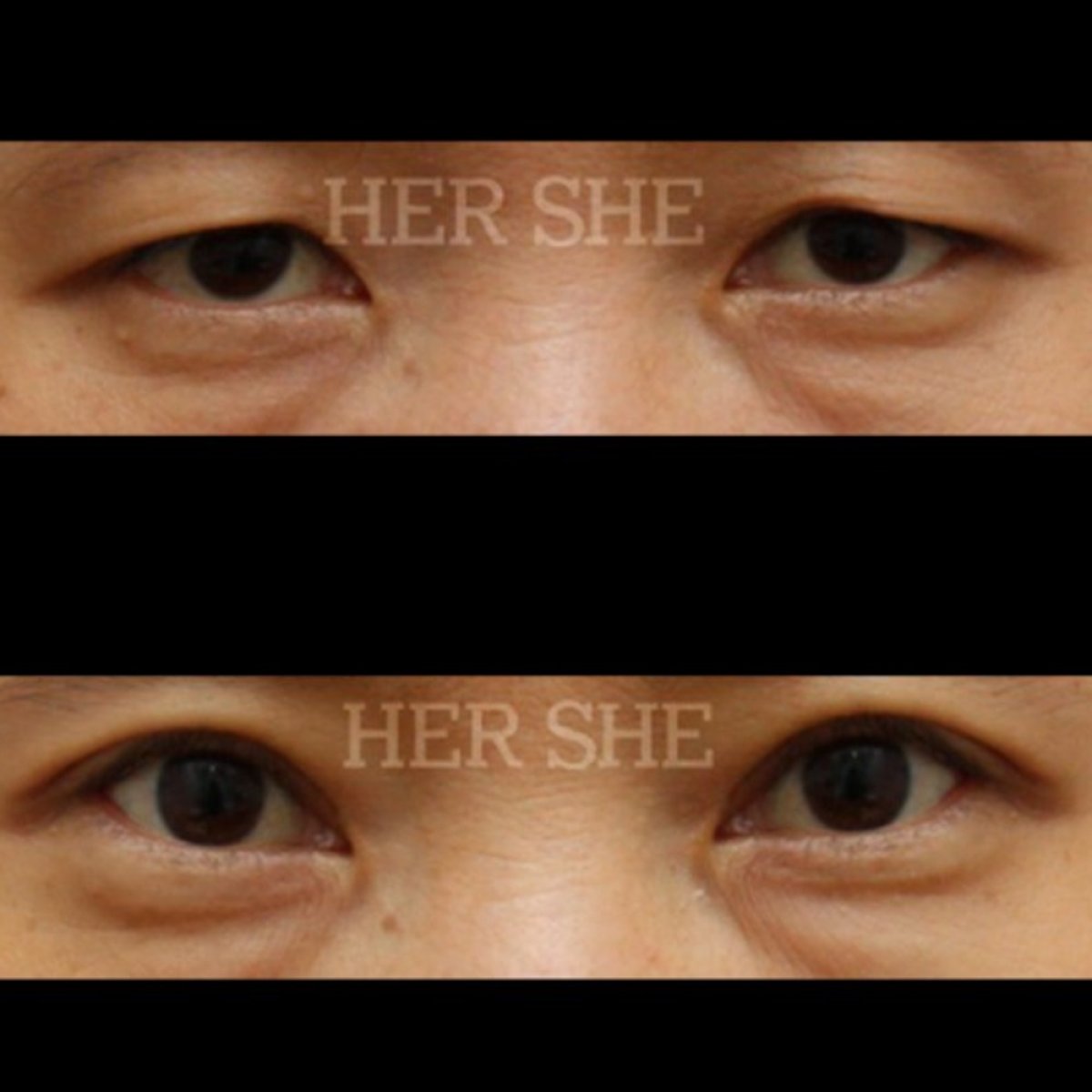Resultados de blefaroplastia antes y después en HERSHE Plastic Surgery Korea, corrección de párpados