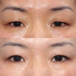 Fotos vor und nach Blepharoplastik (Augenlidkorrektur) durch Dr. 