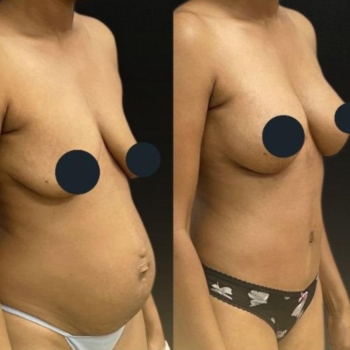 Before and after tummy tuck results at Memorial Göztepe Hospital, improved abdominal contour