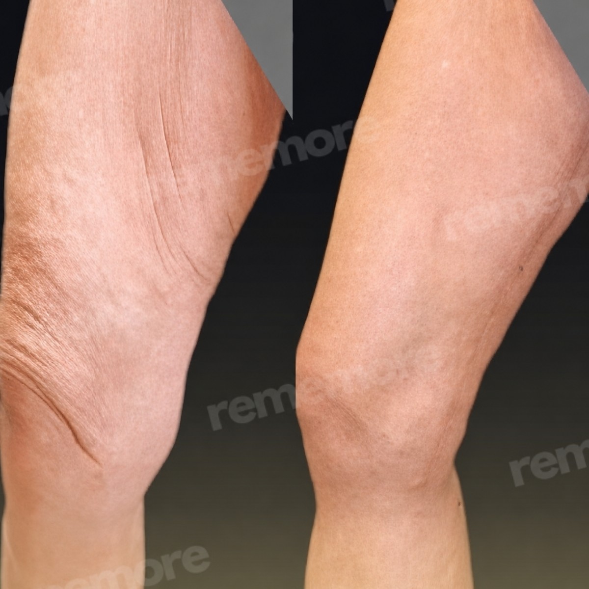 Before and after thigh lift results at Memorial Göztepe Hospital, smoother and firmer thighs