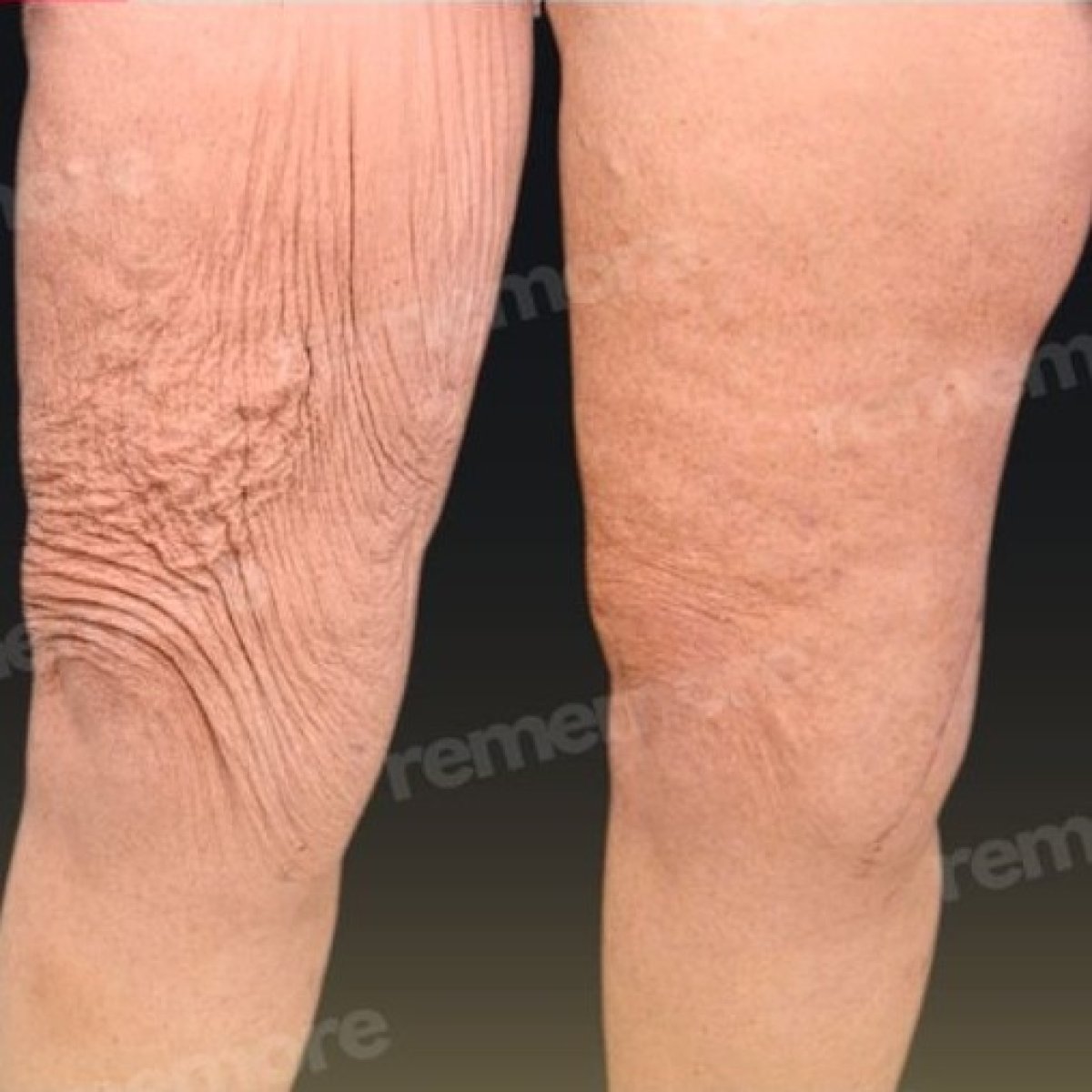Before and after thigh lift results at Memorial Göztepe Hospital, improved skin tightness