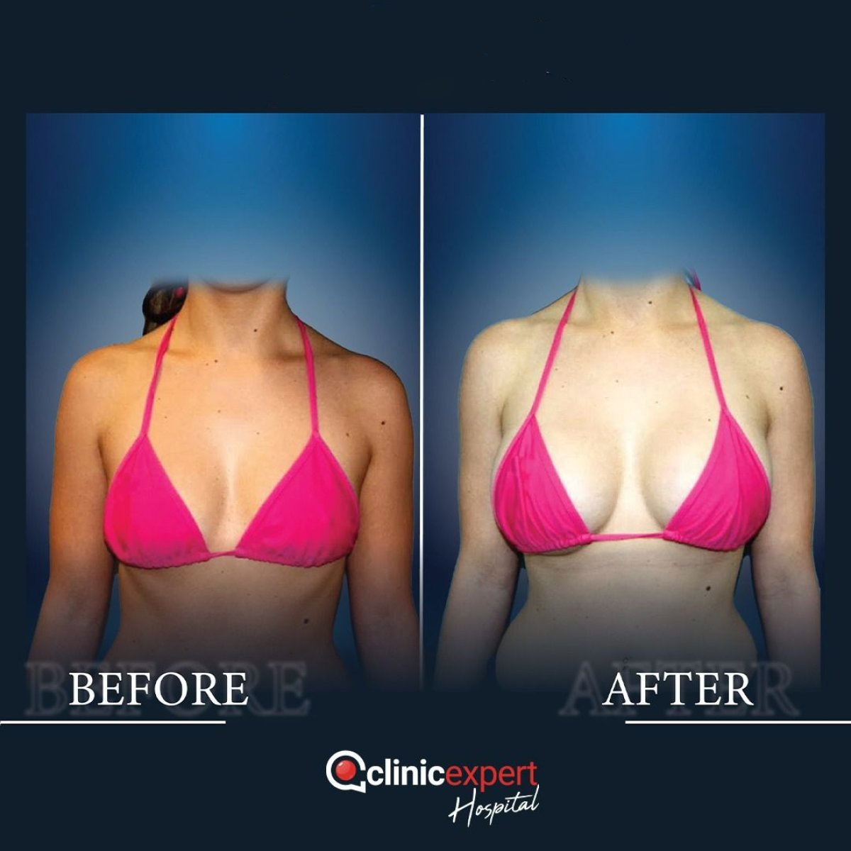 Before and after breast implants with lift results at CE International Hospital