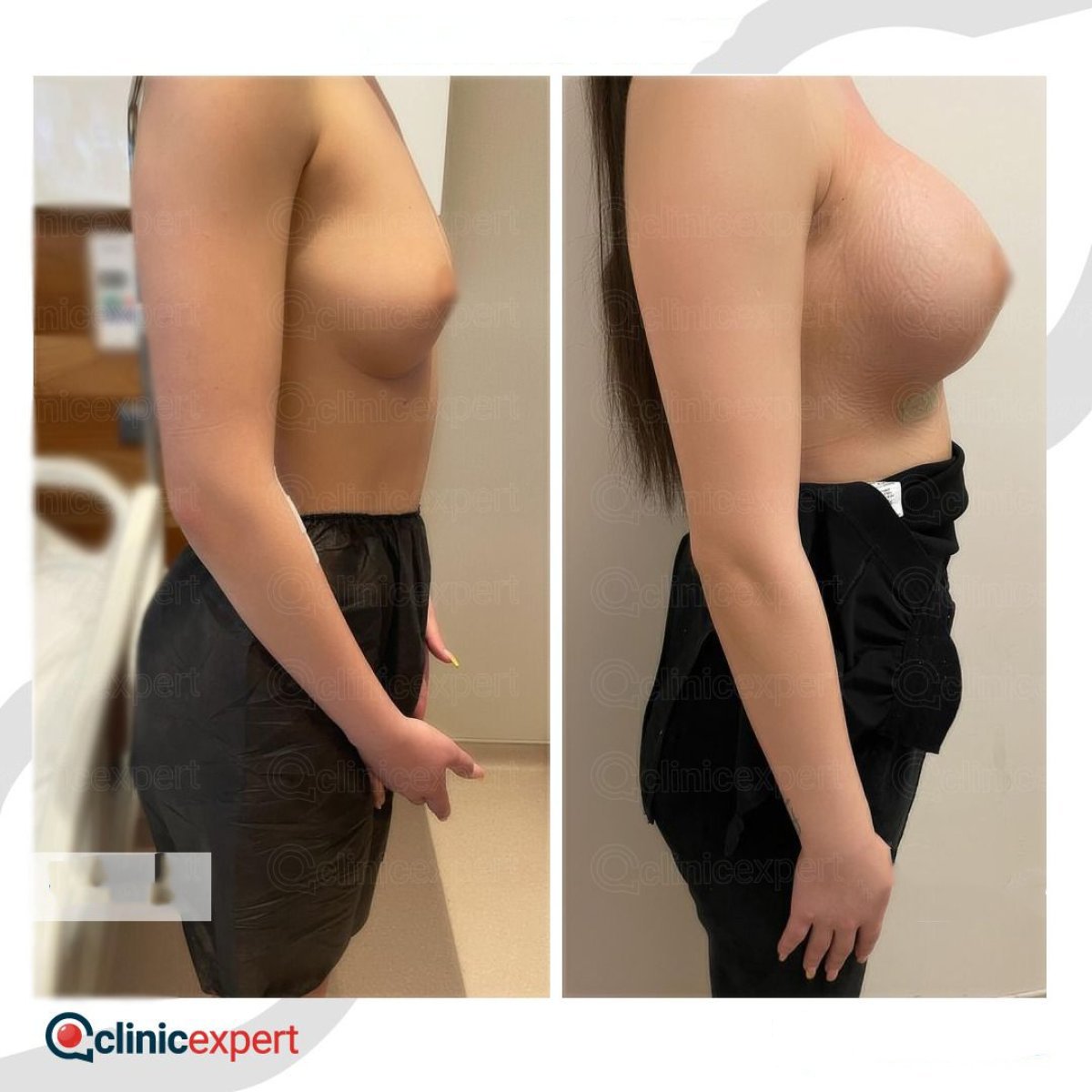 Before and after breast implants with lift results at CE International Hospital, enhanced contour