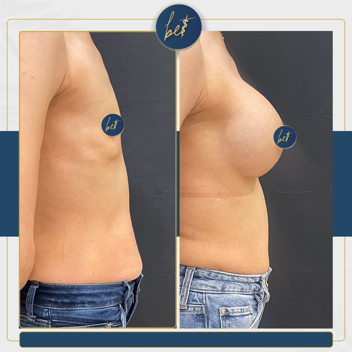 Before and after mammoplasty results at Medipol Acibadem District Hospital, breast augmentation