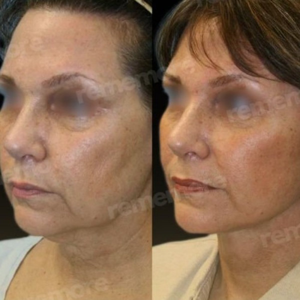 Before and after brow lift results at Memorial Şişli Hospital, visible eyebrow and forehead lift