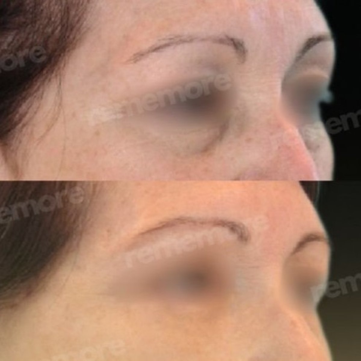 Before and after brow lift results at Memorial Şişli Hospital, visible eyebrow lift improvement
