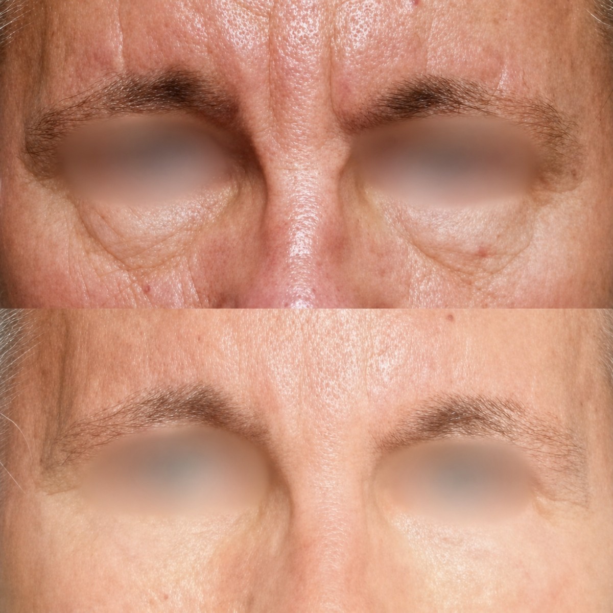 Before and after brow lift results at Memorial Şişli Hospital, smoother forehead and lifted brows