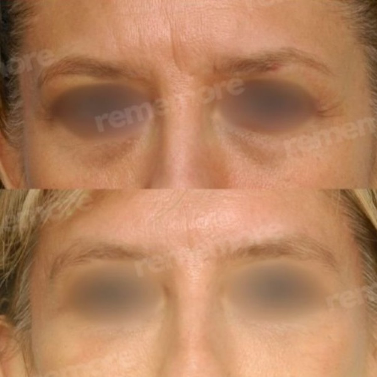 Before and after brow lift results at Memorial Şişli Hospital, visible eyebrow lift improvement