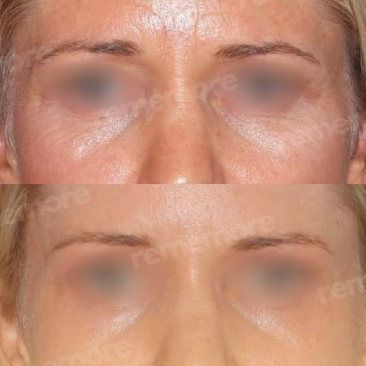 Before and after brow lift results at Memorial Şişli Hospital, smoother forehead and lifted brows