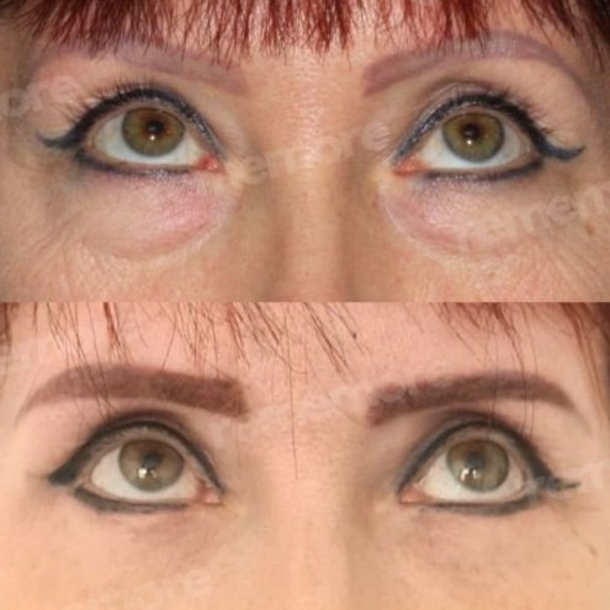 Before and after blepharoplasty results at Memorial Şişli Hospital, eyelid correction surgery