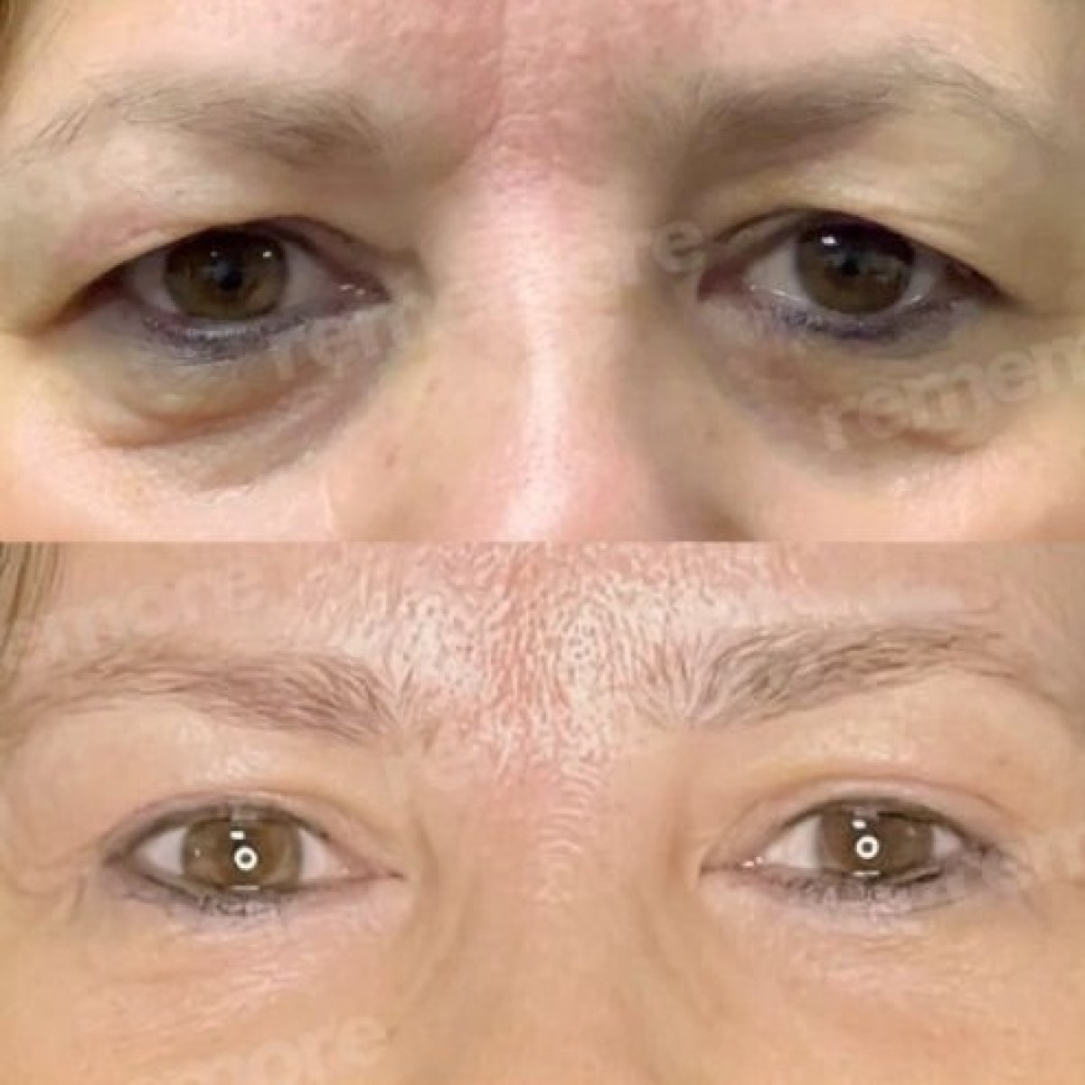 Before and after blepharoplasty results at Memorial Şişli Hospital, eyelid correction improvement