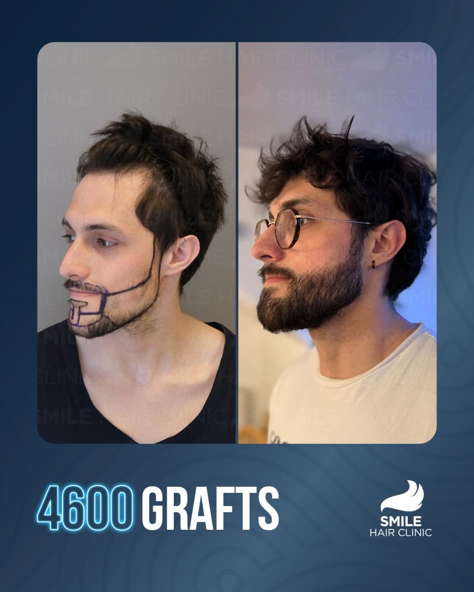 Before and after beard transplant result with 4600 grafts at Smile Hair Clinic