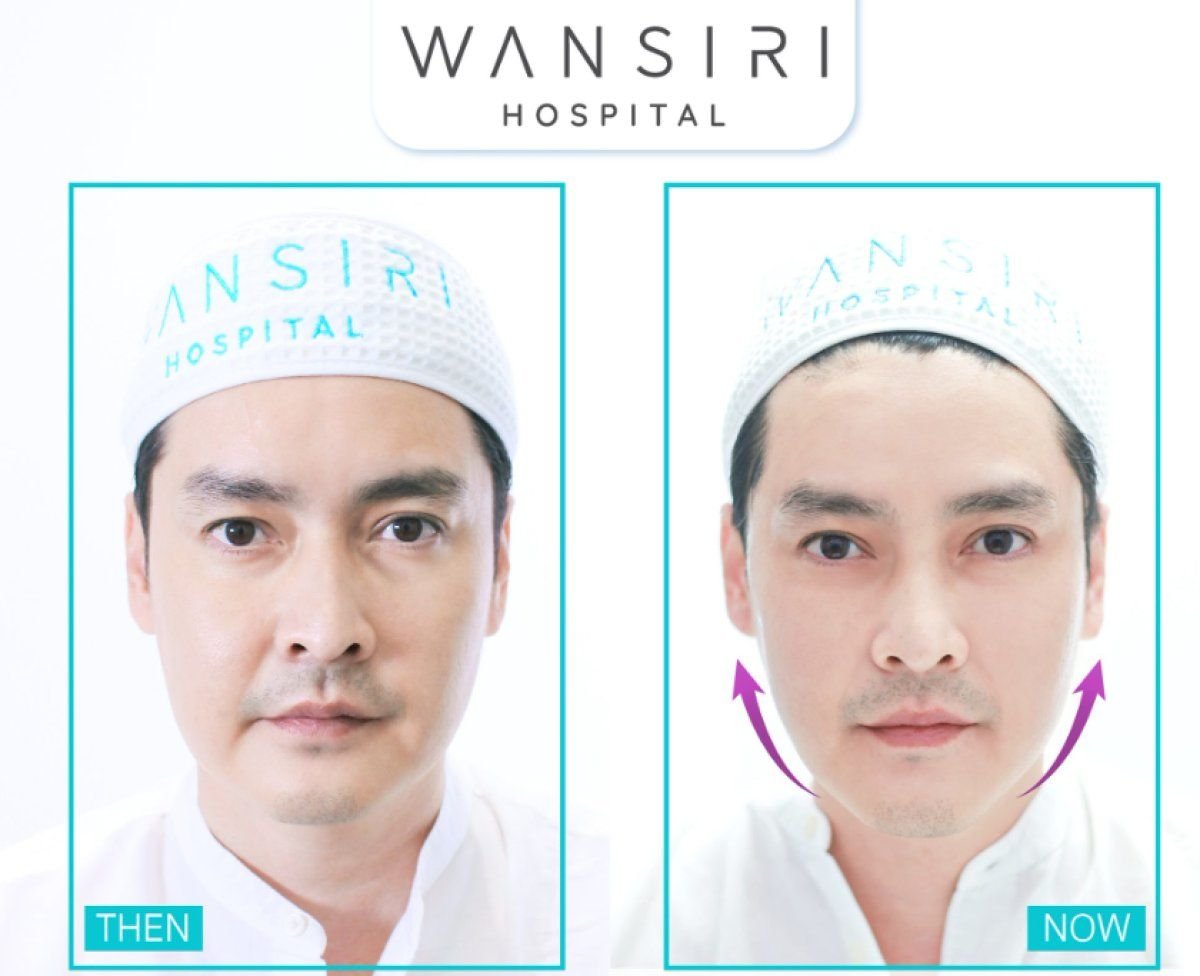 Avant/après injections de botox à Wansiri Hospital – amélioration visible du contour du visage