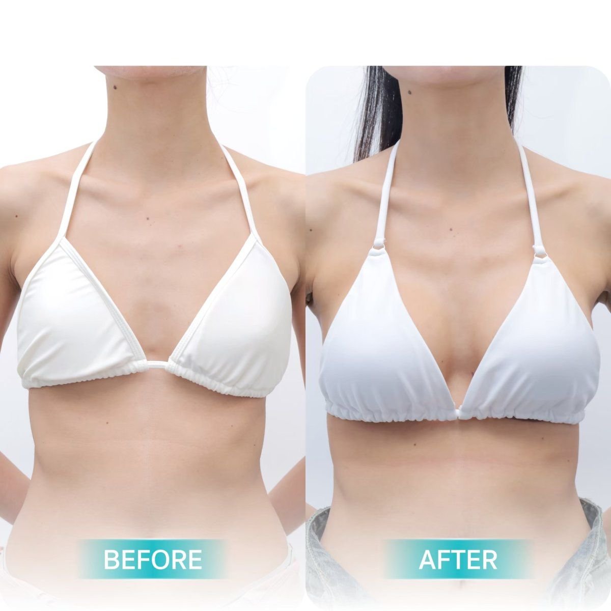 Before and after breast augmentation results at Wansiri Hospital, enhanced breast volume