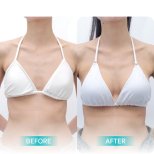 Before and after Breast augmentation photos by Dr. Saran Wannachamras