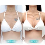 Before and after Breast augmentation photos by Dr. Saran Wannachamras