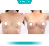 Before and after Breast augmentation photos by Dr. Saran Wannachamras