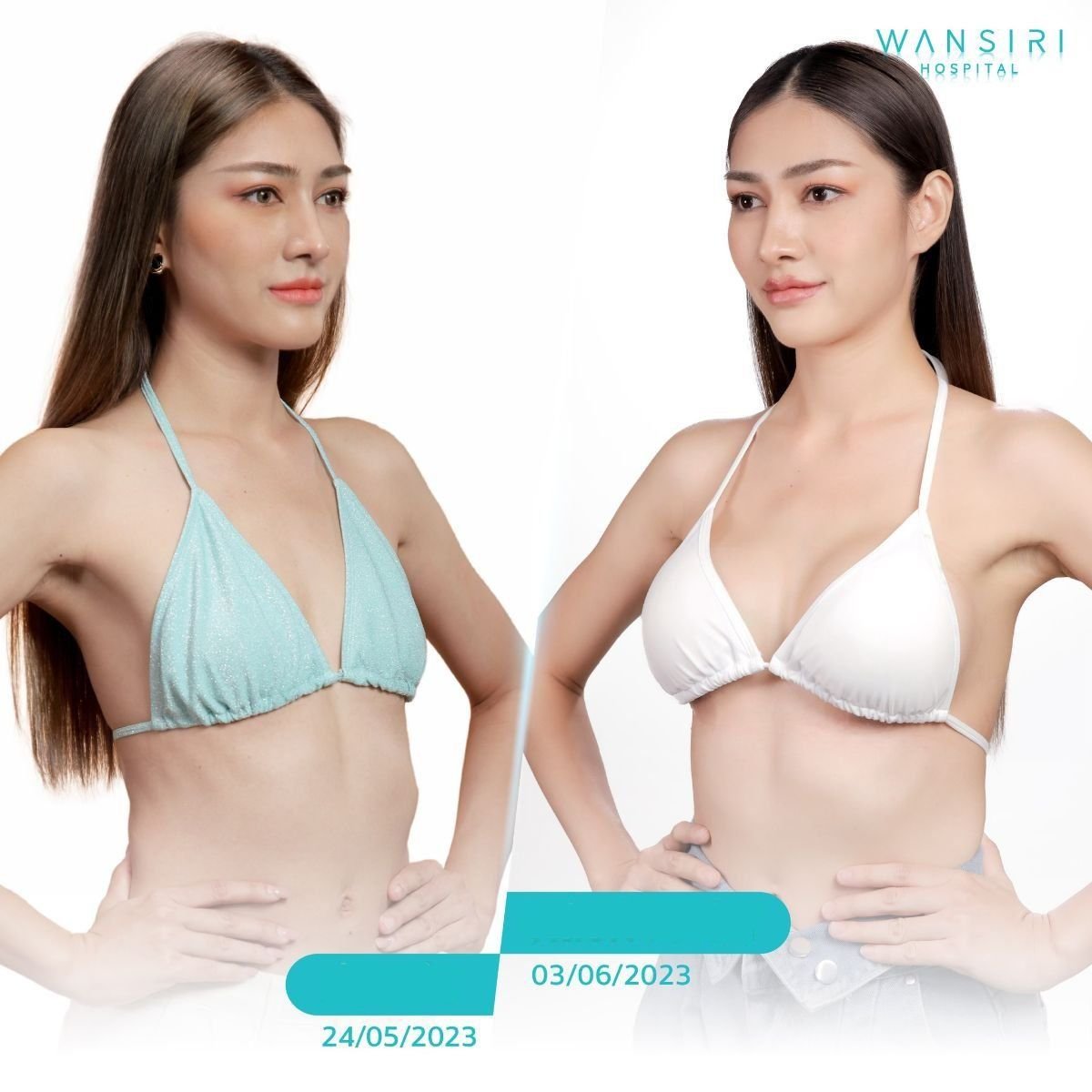 Before and after breast augmentation at Wansiri Hospital, enhanced breast size results