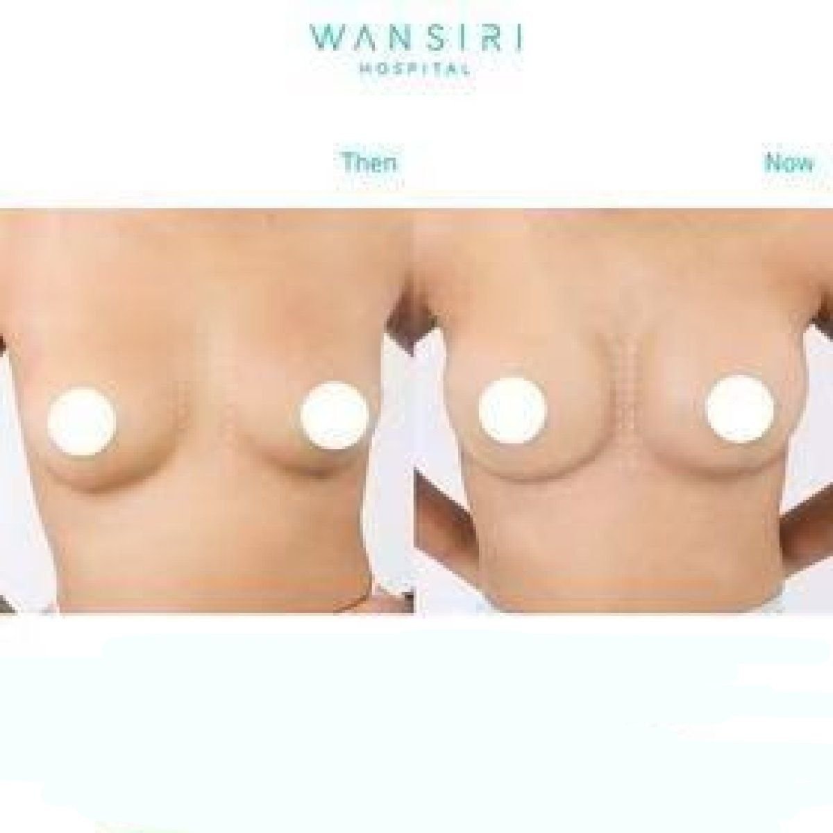 Resultados antes y después de aumento de senos en Wansiri Hospital, forma mejorada