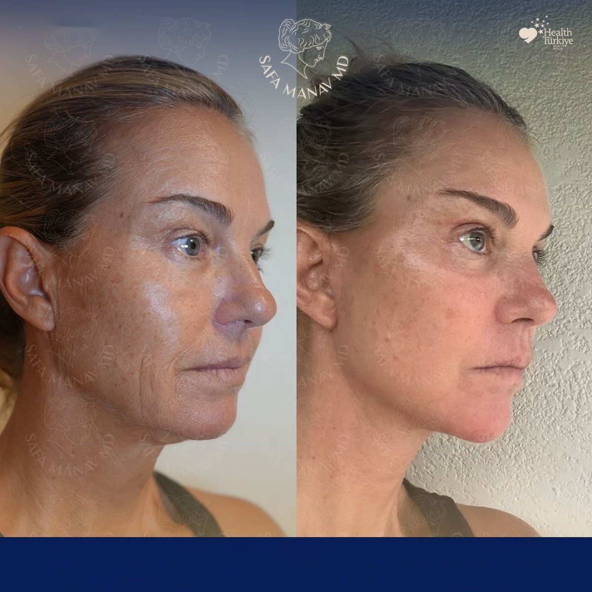 Before and after brow lift results at Dr. Safa Manav Clinic, visible forehead and eye rejuvenation