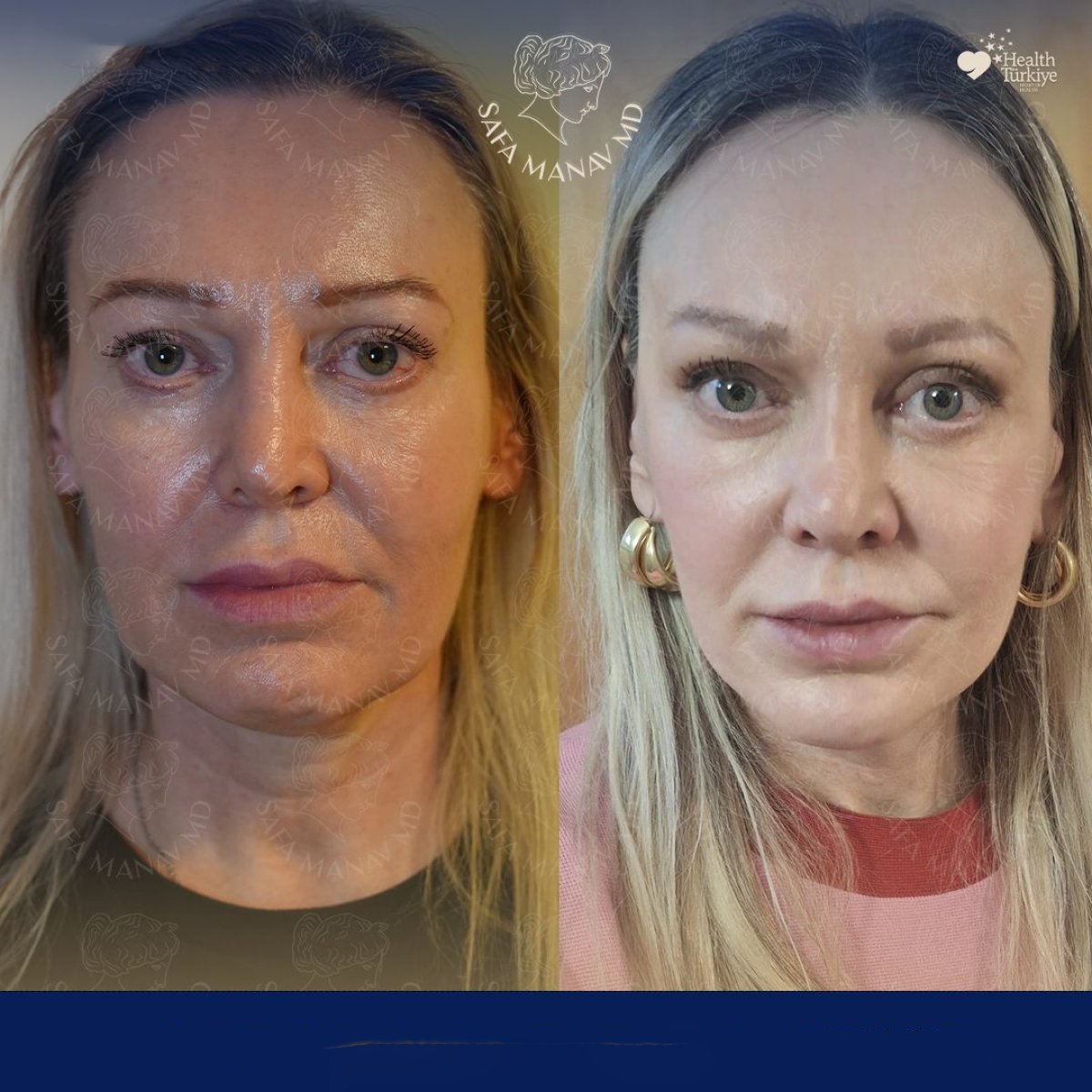 Resultados de lifting de cejas antes y después en Dr. Safa Manav Clinic, rejuvenecimiento visible