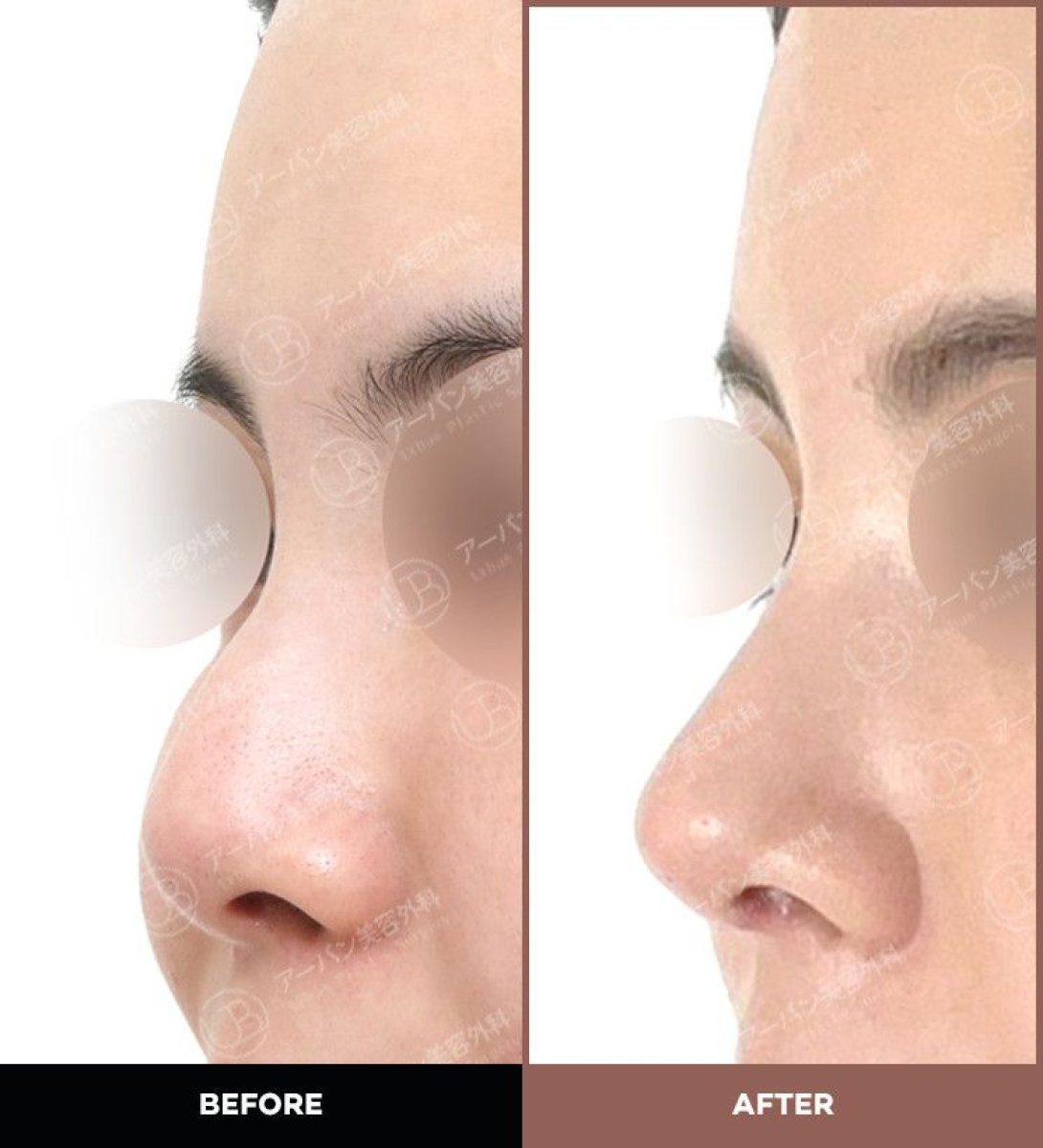 Before and after rhinoplasty results at URBAN Plastic Surgery, improved nose profile