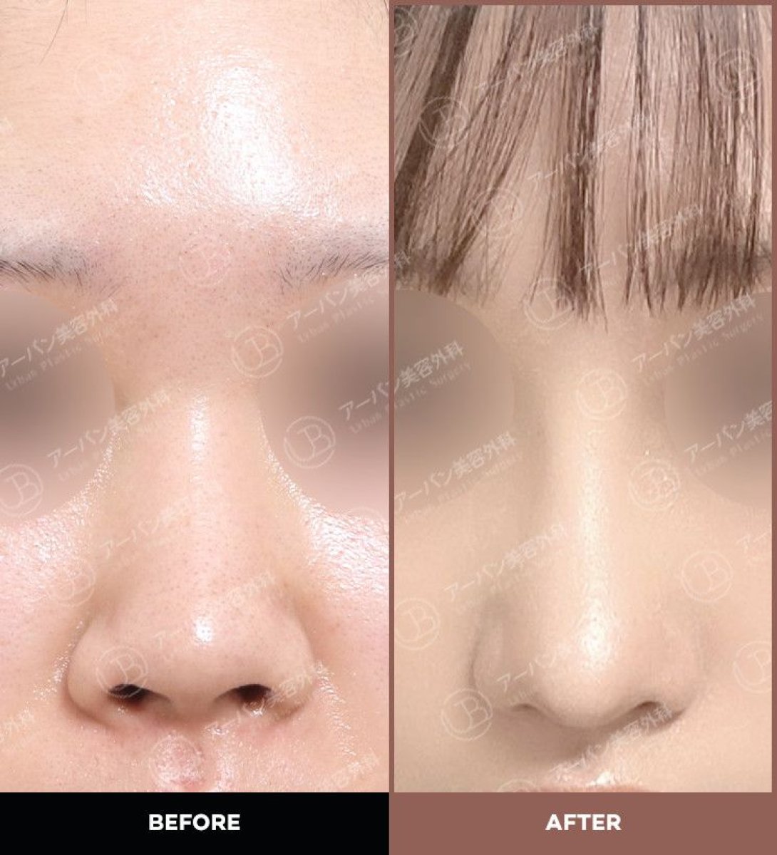 نتائج تجميل الأنف قبل وبعد في URBAN Plastic Surgery، تحسين شكل الأنف
