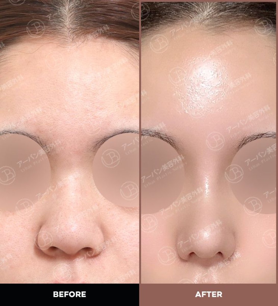Antes y después de alarplastia en URBAN Plastic Surgery, resultados de refinamiento nasal